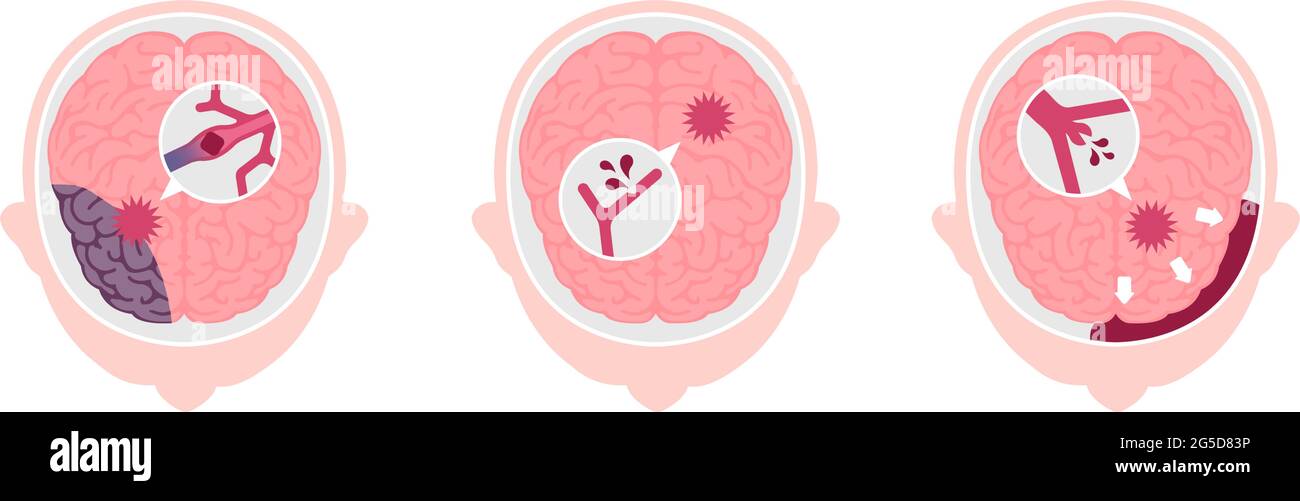 Types of human brain stroke vector illustration Stock Vector Image ...