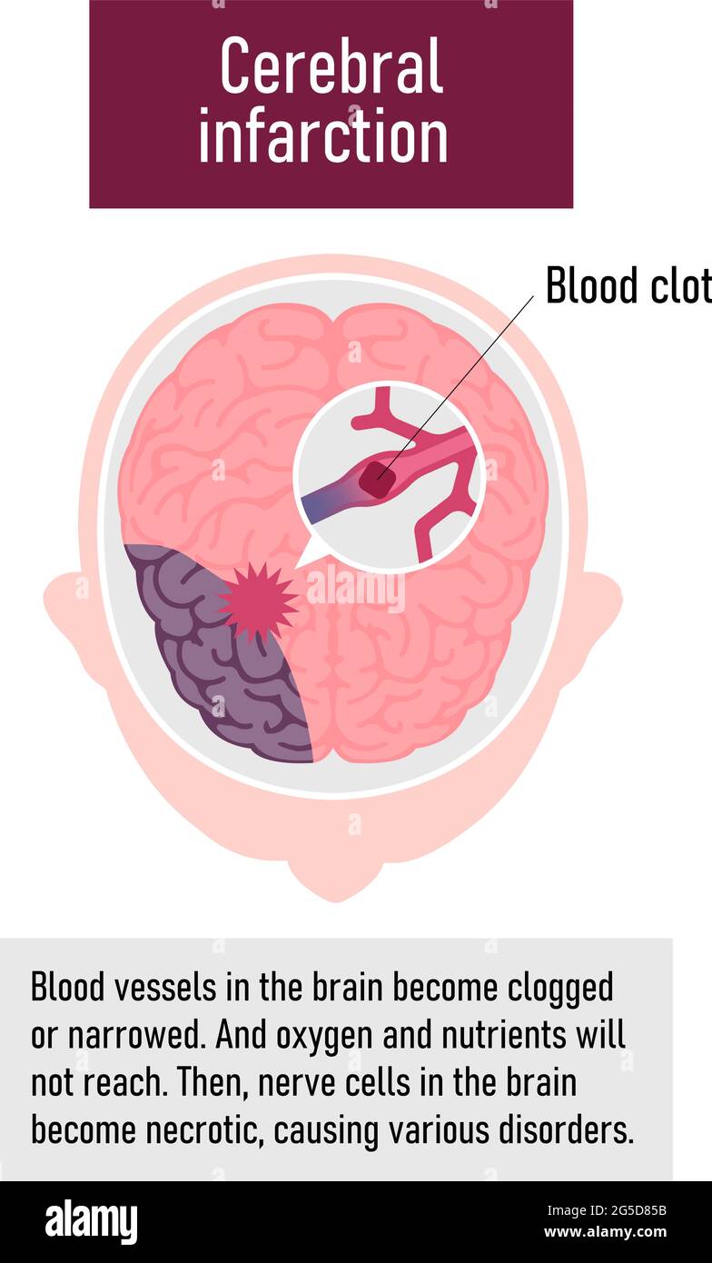 Types of human brain stroke vector illustration | Cerebral infarction Stock Vector