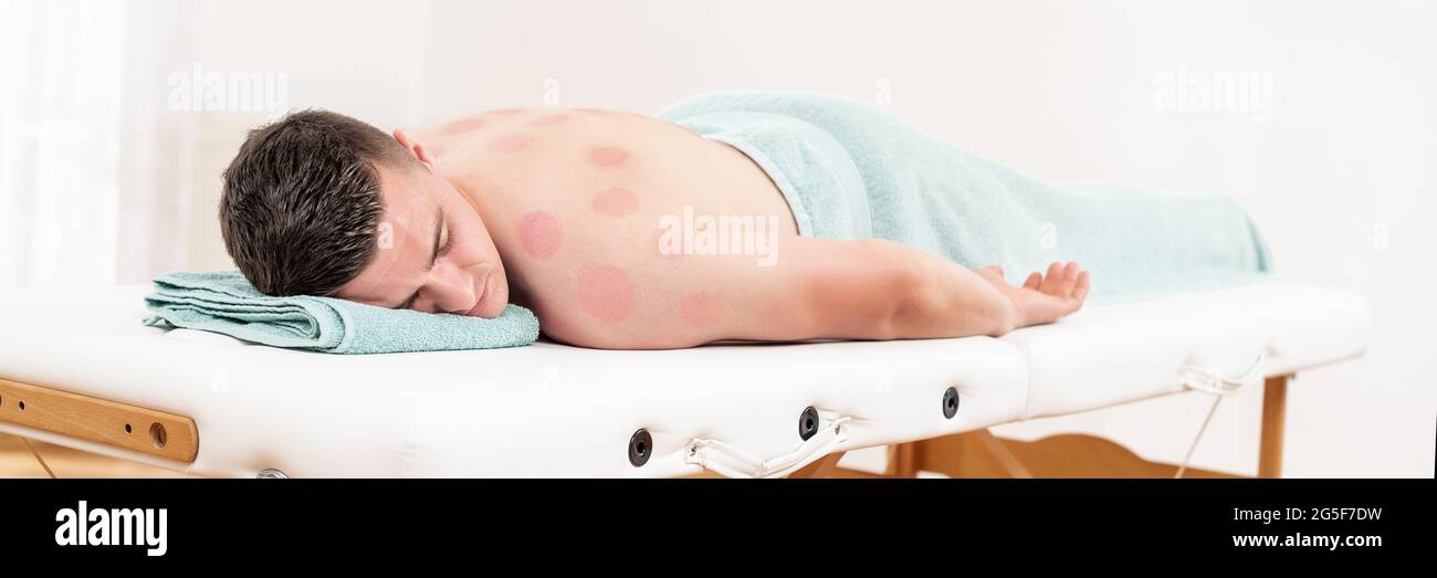 Young man relaxing after vacuum cupping therapy. Back with skin