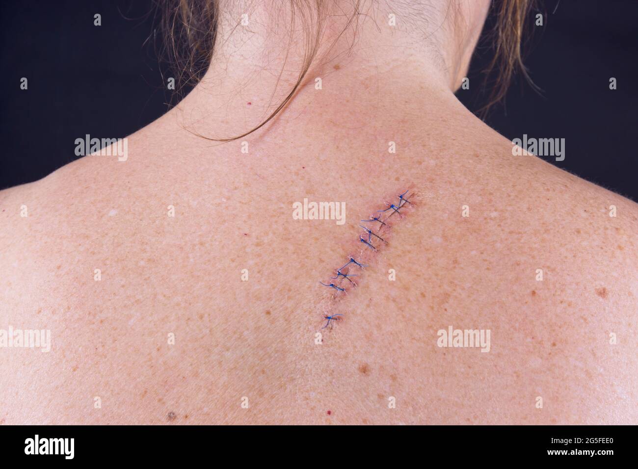Stitches on the back of a woman after and operation to remove a mole