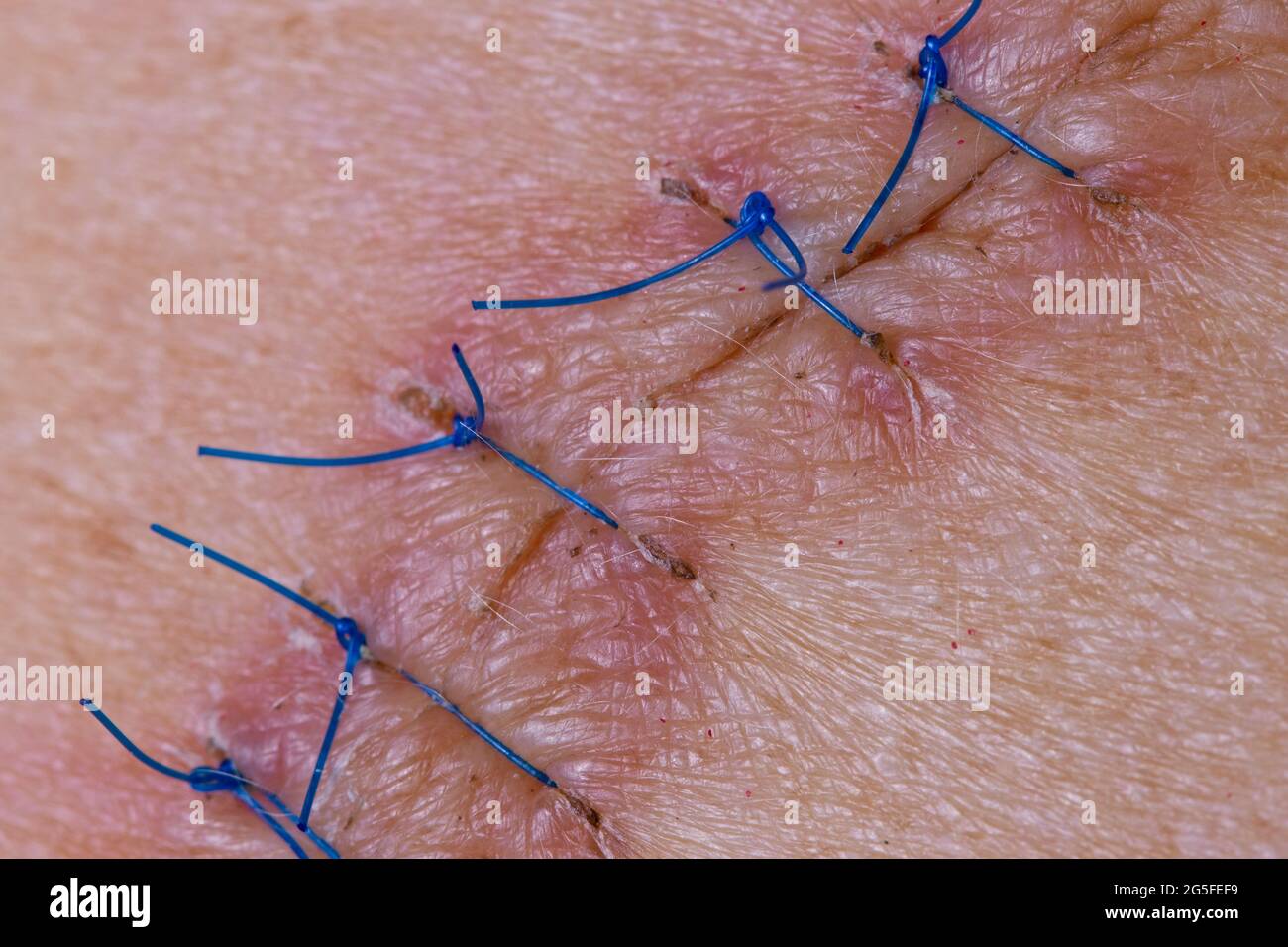 Stitches on the back of a woman after and operation to remove a mole Stock Photo Alamy
