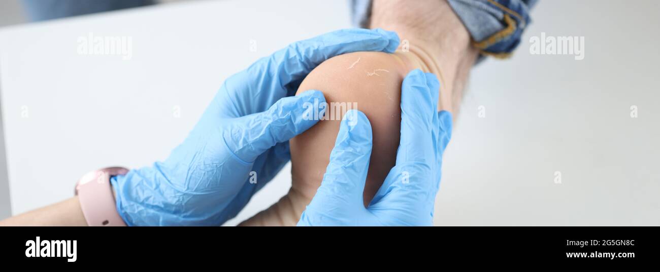 Doctor dermatologist in gloves examining patients heel closeup Stock Photo