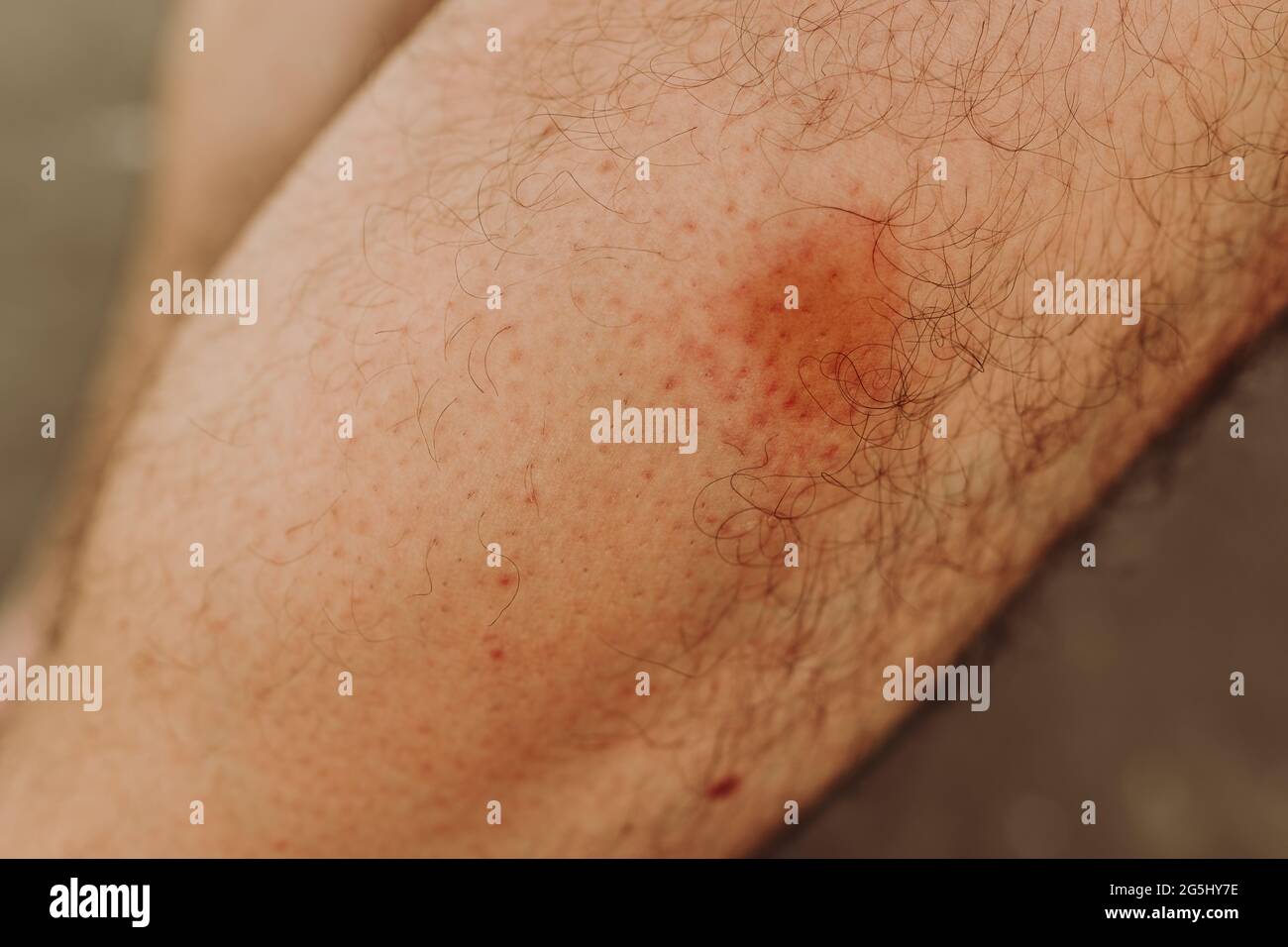 Simuliidae black fly bite mark on the leg below the knee, selective focus Stock Photo