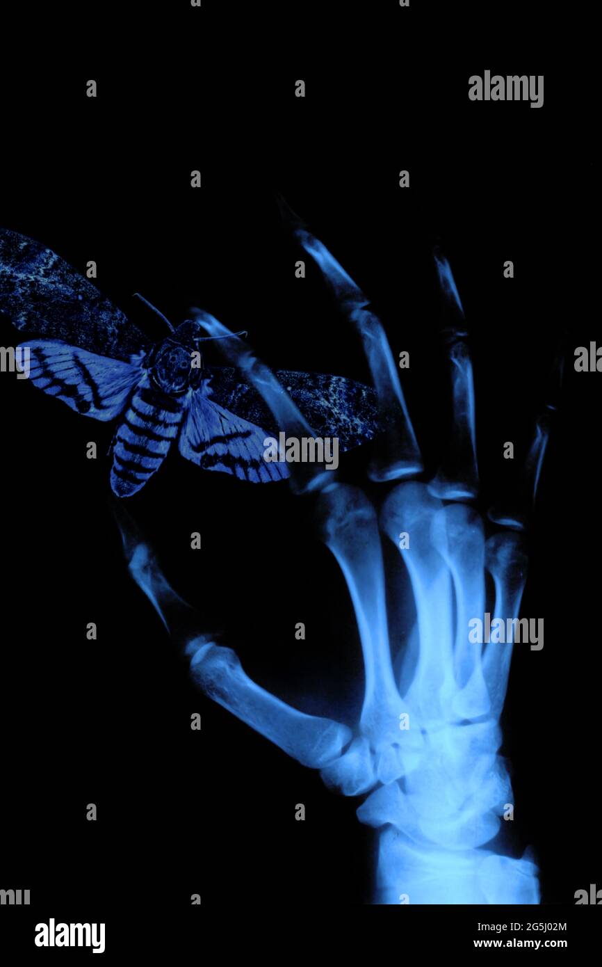 Scan of human hand xray image medical background Stock Photo