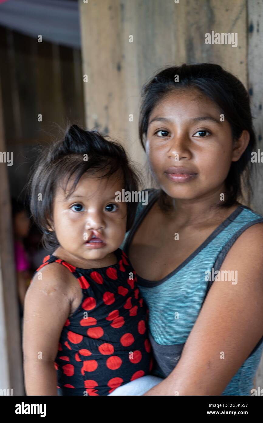 Cleft lip baby hi-res stock photography and images - Alamy