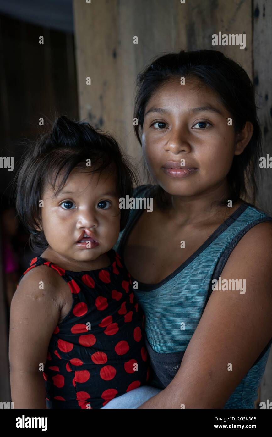 Cleft lip baby hi-res stock photography and images - Alamy