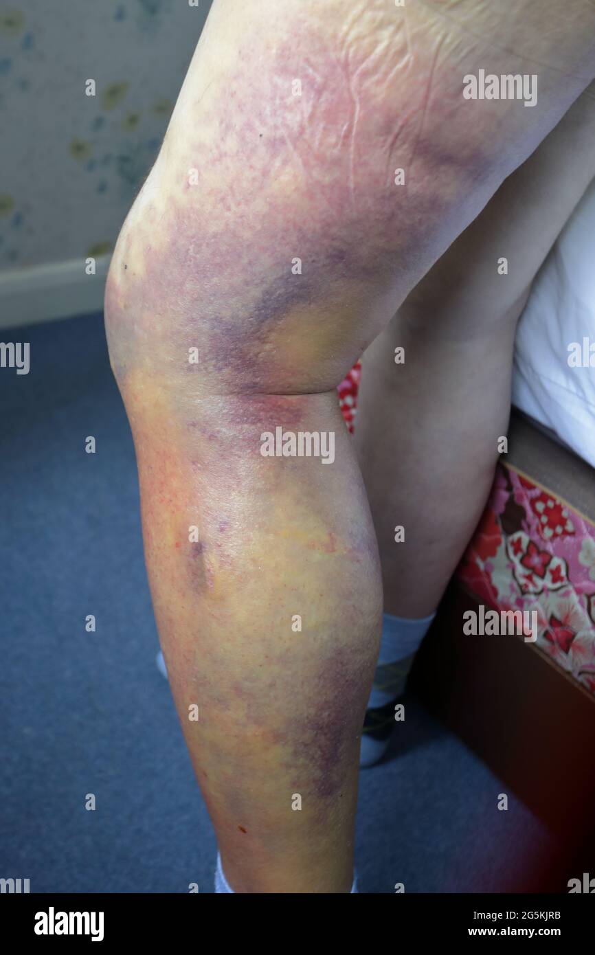 human male leg, showing the bruising (contusiona, haematoma) a week after being hit with a cricket ball (blunt trauma) Stock Photo