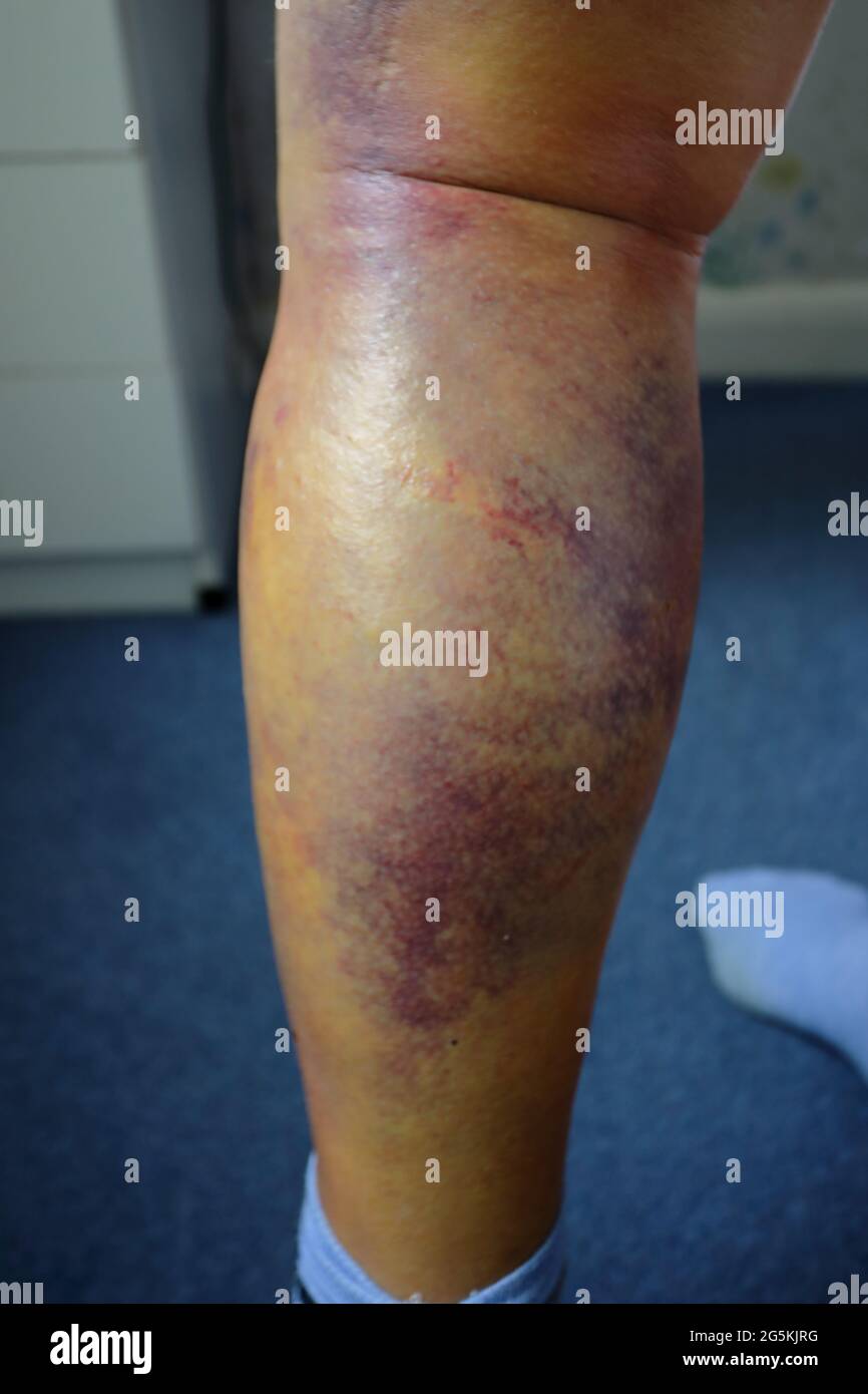 human male leg, showing the bruising (contusiona, haematoma) a week after being hit with a cricket ball (blunt trauma) Stock Photo
