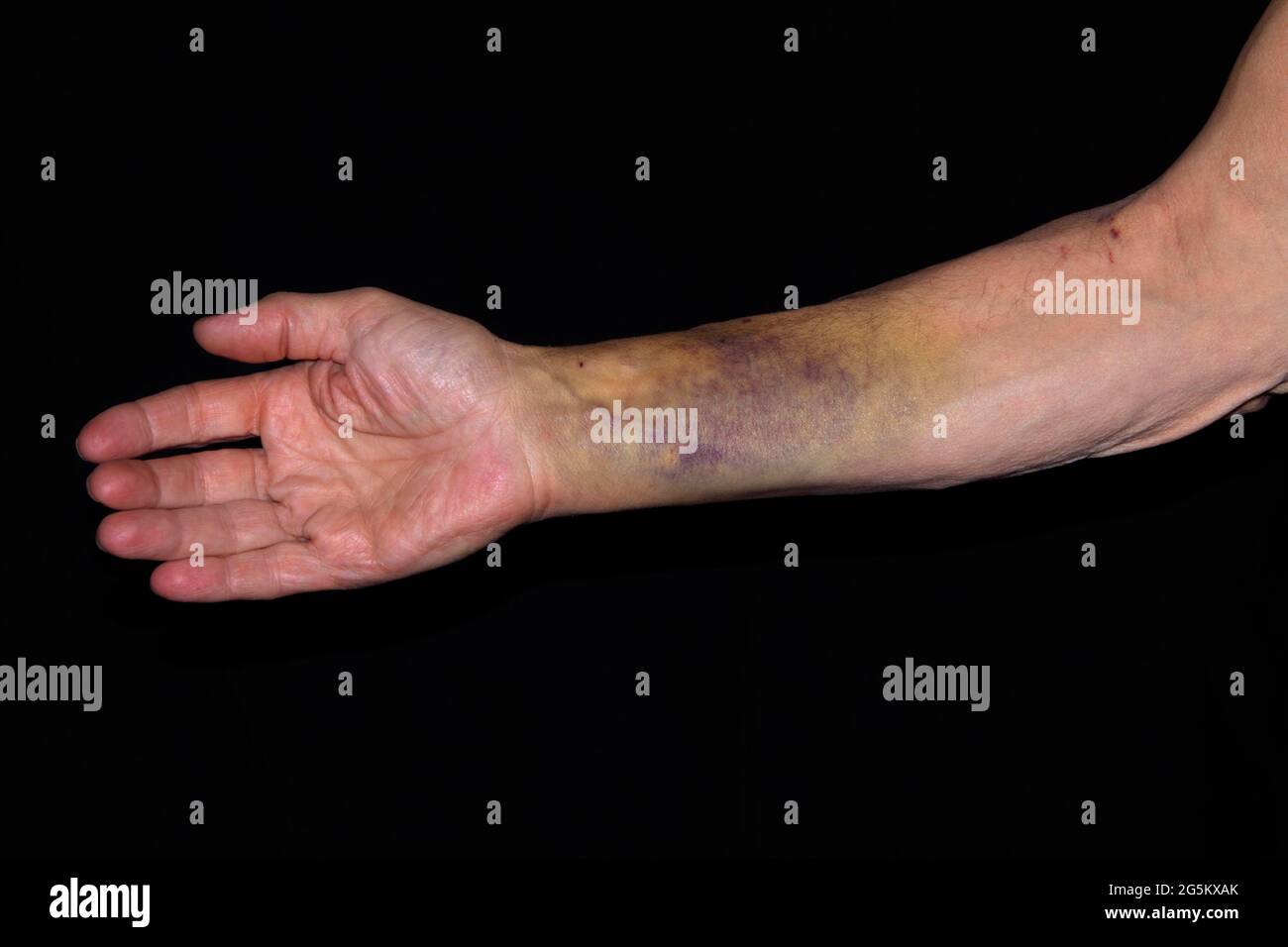 Patient With A Bruise Hematoma On The Right Arm After Insertion Of A