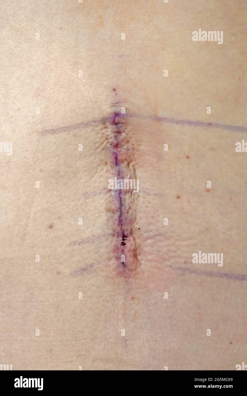 Along the spine, a four inch incision site is shown the day after a lumbar operation at a hospital. Stock Photo