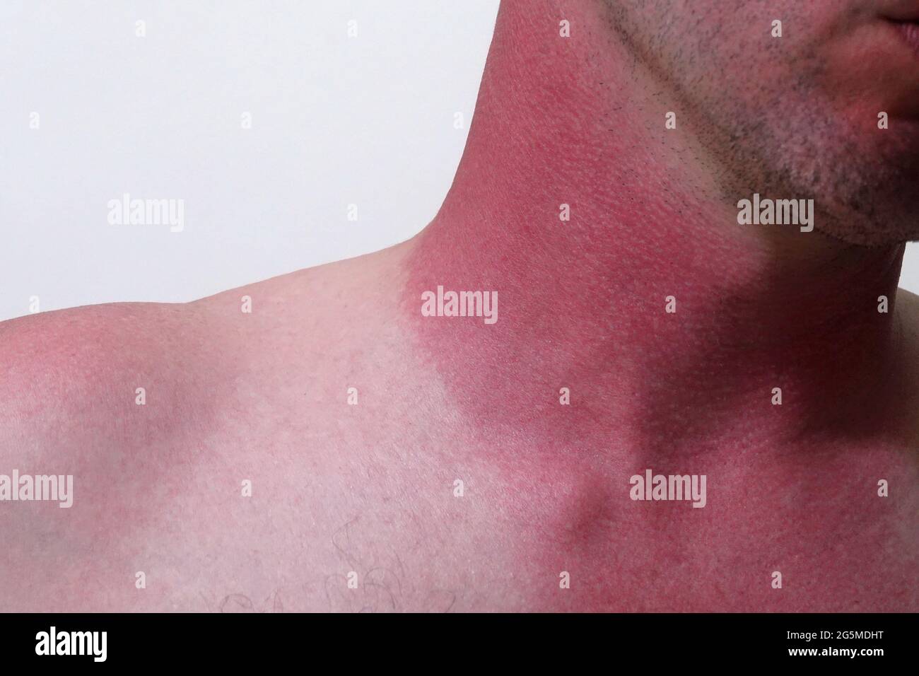 Red irritation from a sunburn is shown on the neck of a white male in an up close view. Stock Photo