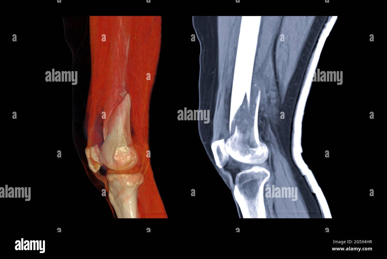 Compare of CT knee joint 3D rendering image lateral view and Sagittal ...