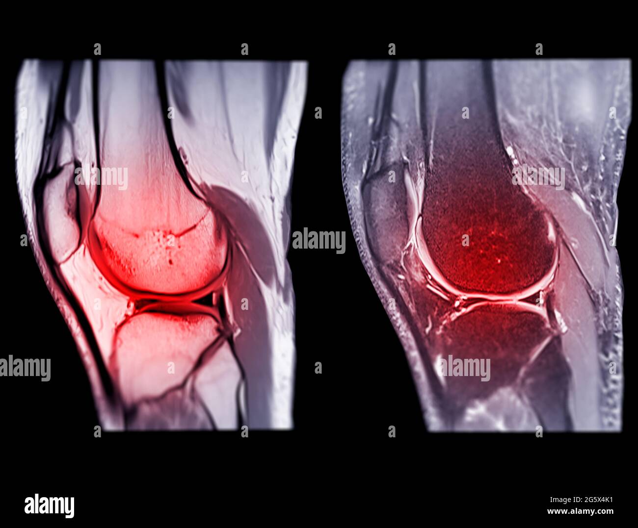 Magnetic resonance imaging or MRI knee comparison sagittal PDW and TIW view for detect tear or sprain of the anterior cruciate  ligament (ACL). Stock Photo