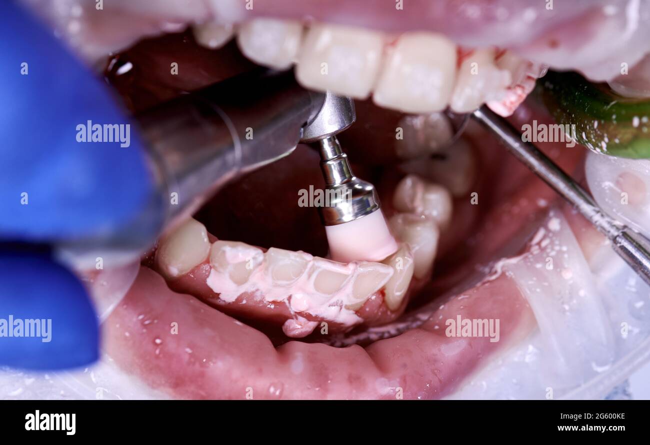 Orthodontist using stainless steel dental polisher and mirror during