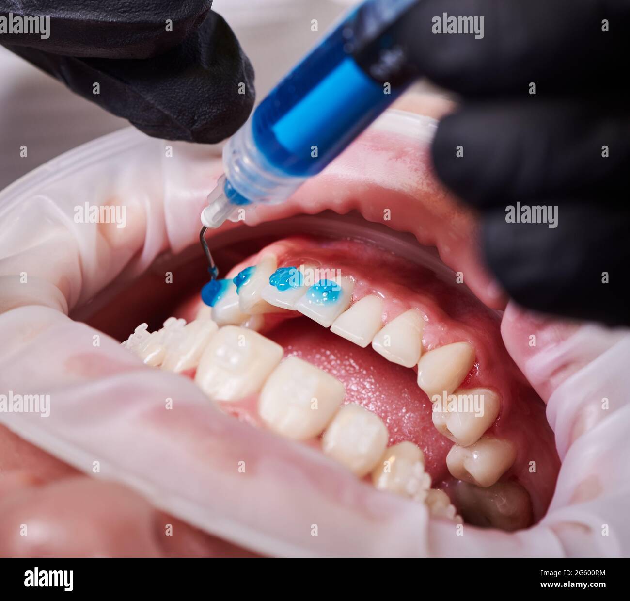 Ceramic braces installation process. Close-up top view on dentist's hands putting some blue glue on patient's clean lower teeth before attaching braces. Dental accessories concept Stock Photo