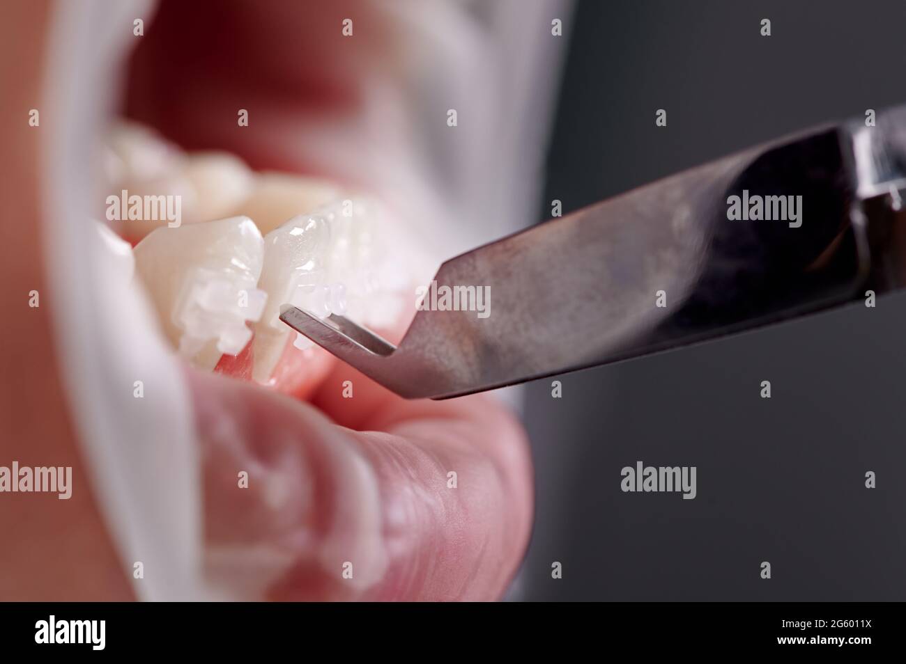 Close up of dental forceps holding ceramic bracket attaching it to clean white tooth of lower jaw. Macro photography. Stomatology and orthodontic treatment concept Stock Photo