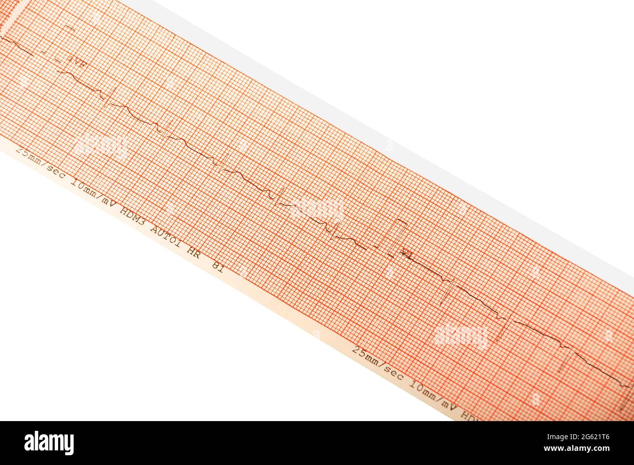 ECG test results on millimeter paper, heart rhythm results, close up of ECG Graph details Stock Photo