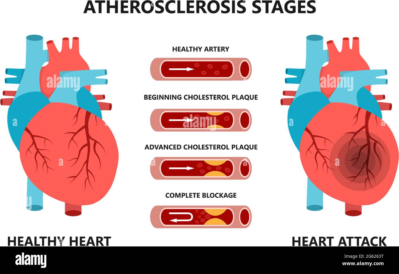 Heart attack and atherosclerosis stages. Healthy and unhealthy arteries. Cholesterol in the blood vessels. Stock Vector