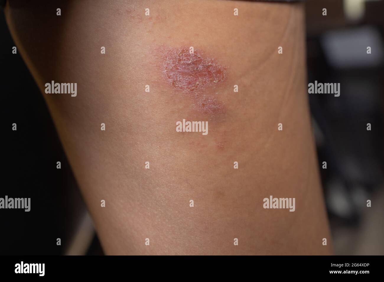 Abrasion on the woman's knee. Injured leg with a red wound. Medical treatment for first aid Stock Photo