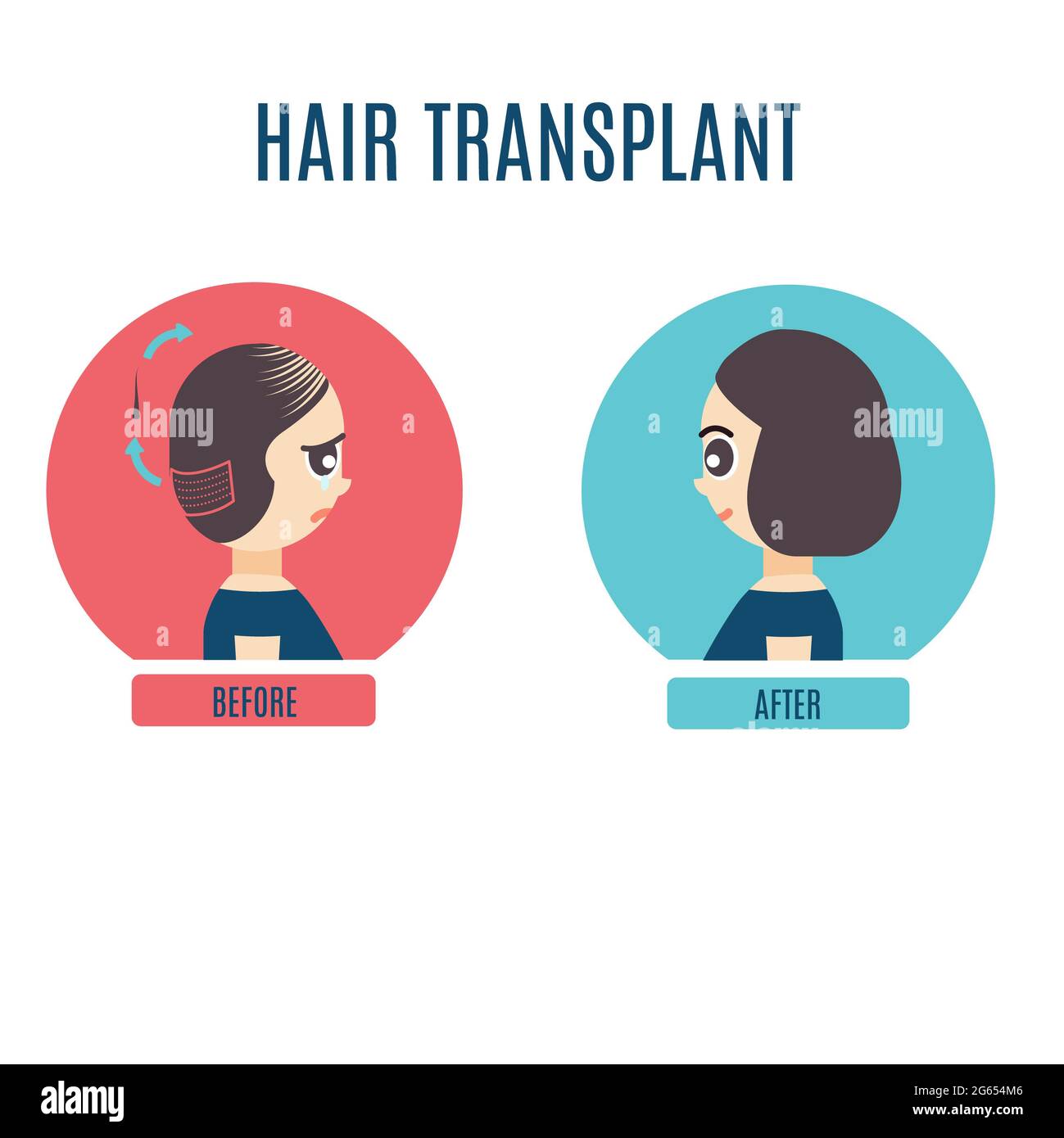 Female hair transplant, illustration Stock Photo
