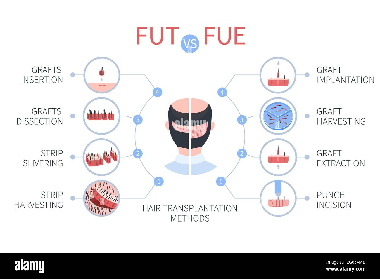 FUE vs FUT hair transplantation, illustration Stock Photo