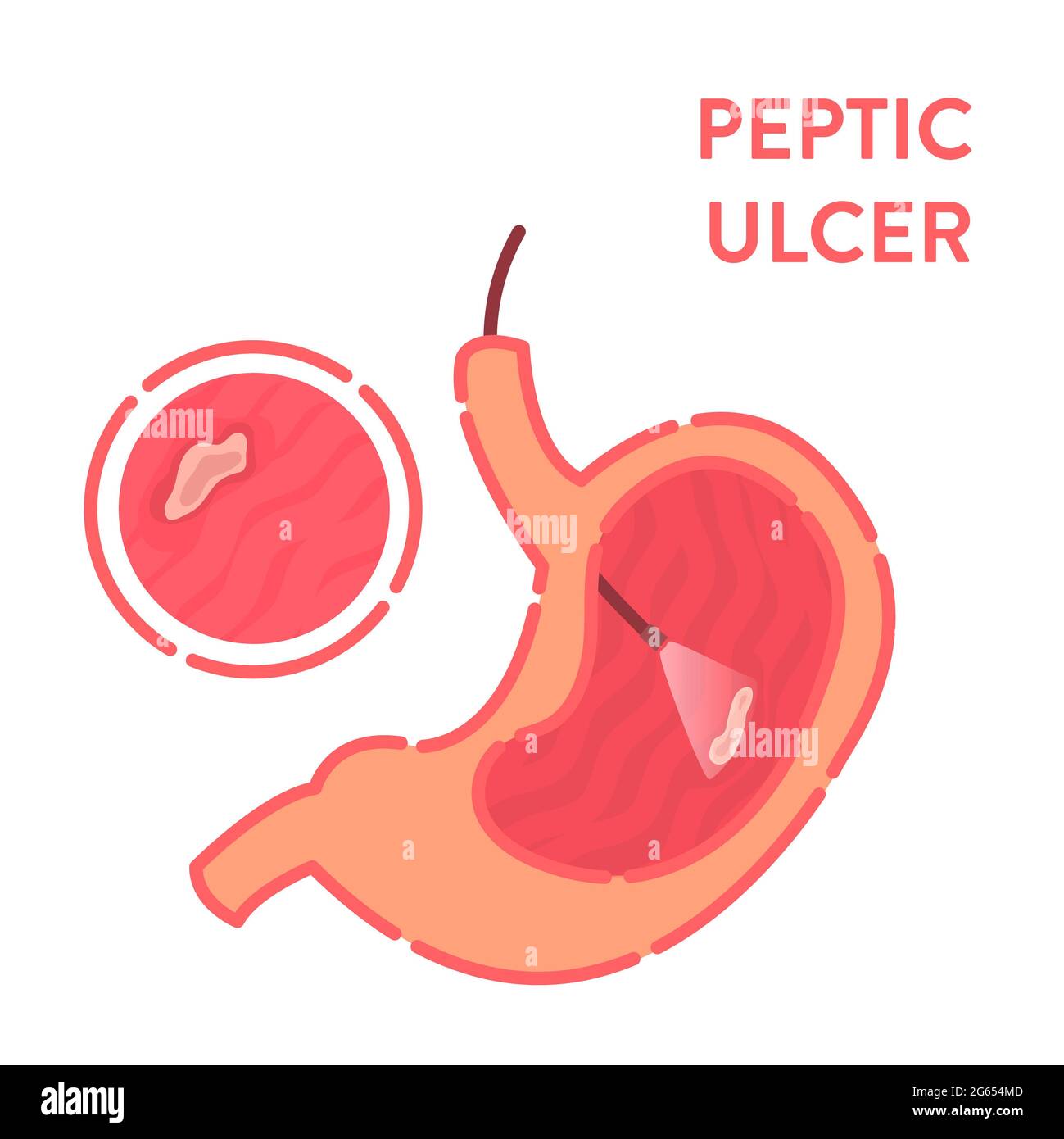 Peptic ulcer diagnosis, conceptual illustration Stock Photo Alamy