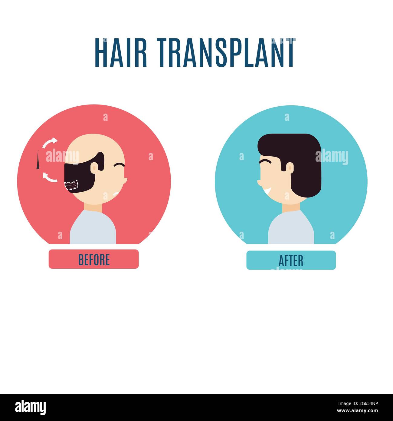 Male hair transplant, illustration Stock Photo