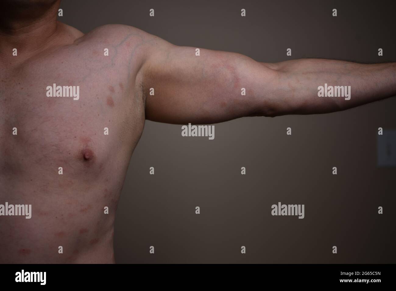 Diagnosis of skin diseases - allergies, psoriasis, eczema, dermatitis. Stock Photo