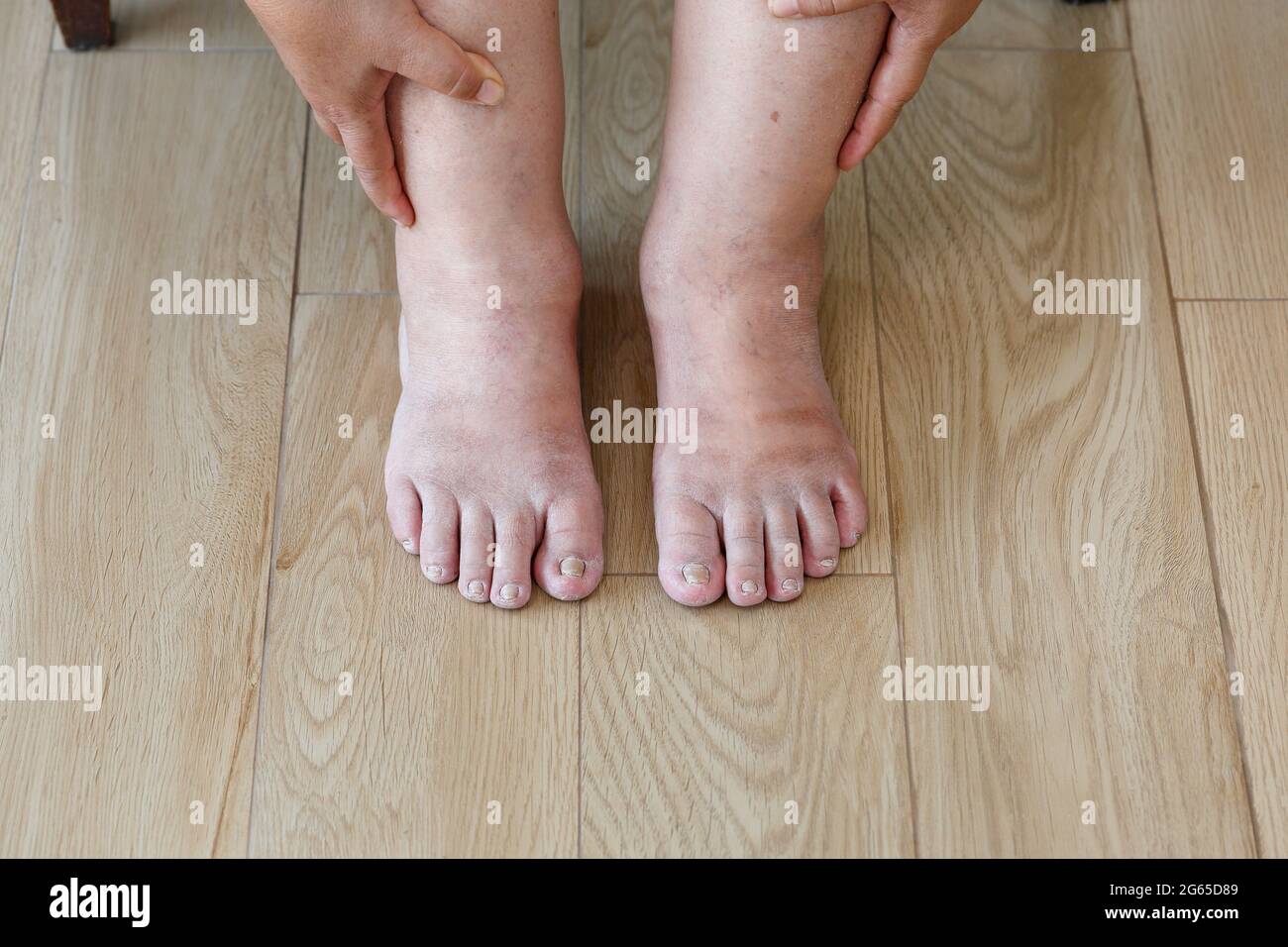 Senior woman swollen feet and leg Stock Photo Alamy