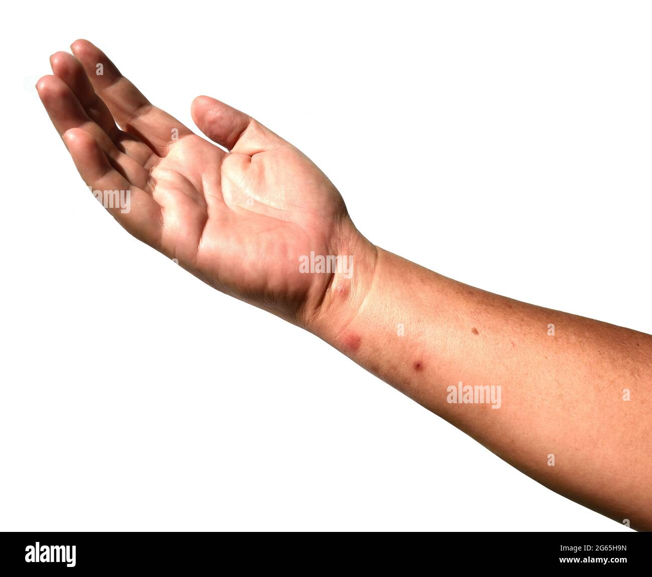 Rashes and red blisters on the skin of human arm and hand islated on white background, Irritation from insect venom, The rash and bumps is caused Stock Photo