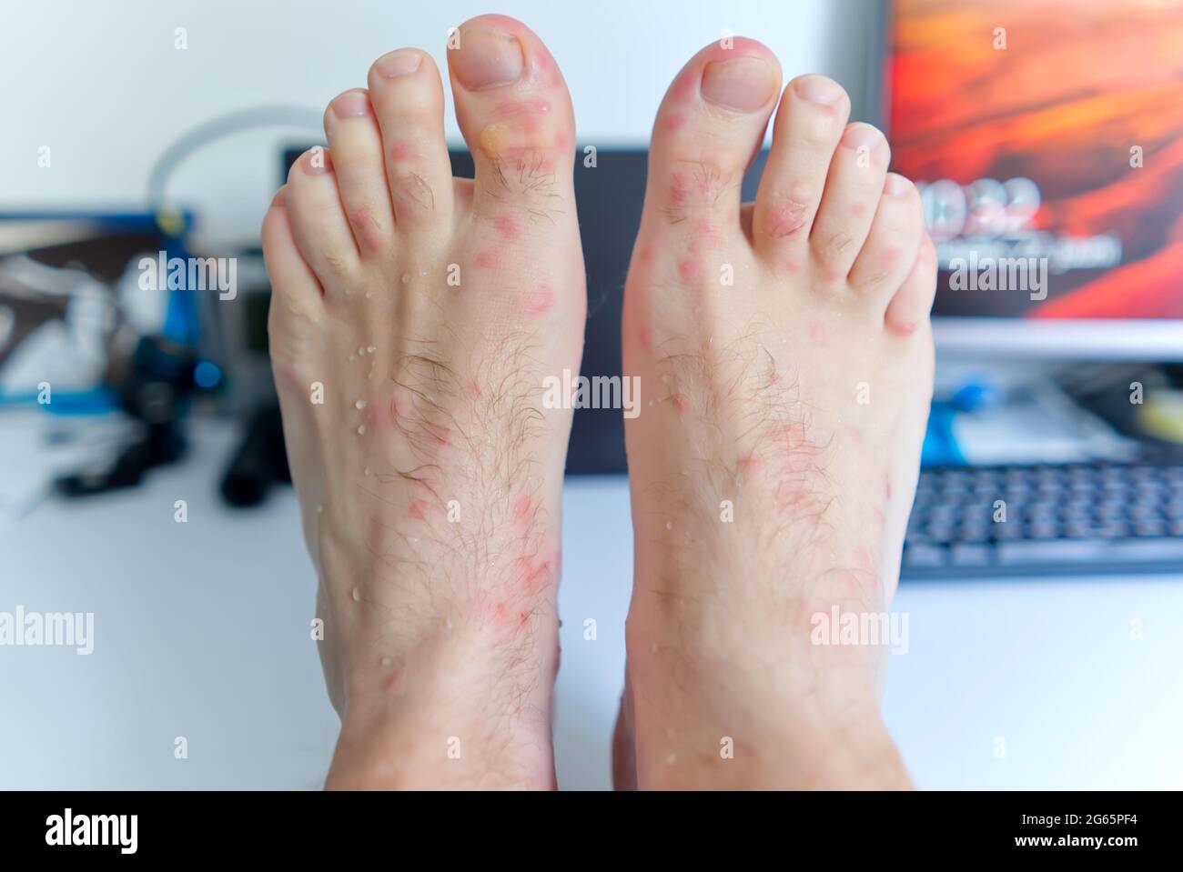 close up on many mosquito bites on men's foot skin Stock Photo Alamy