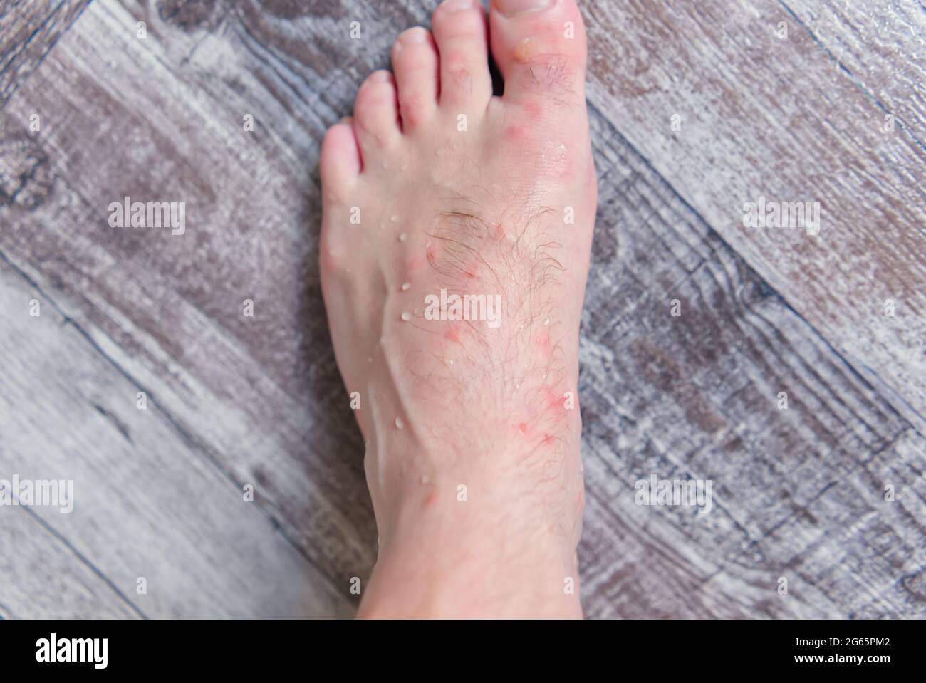 close up on many mosquito bites on men's foot skin Stock Photo Alamy
