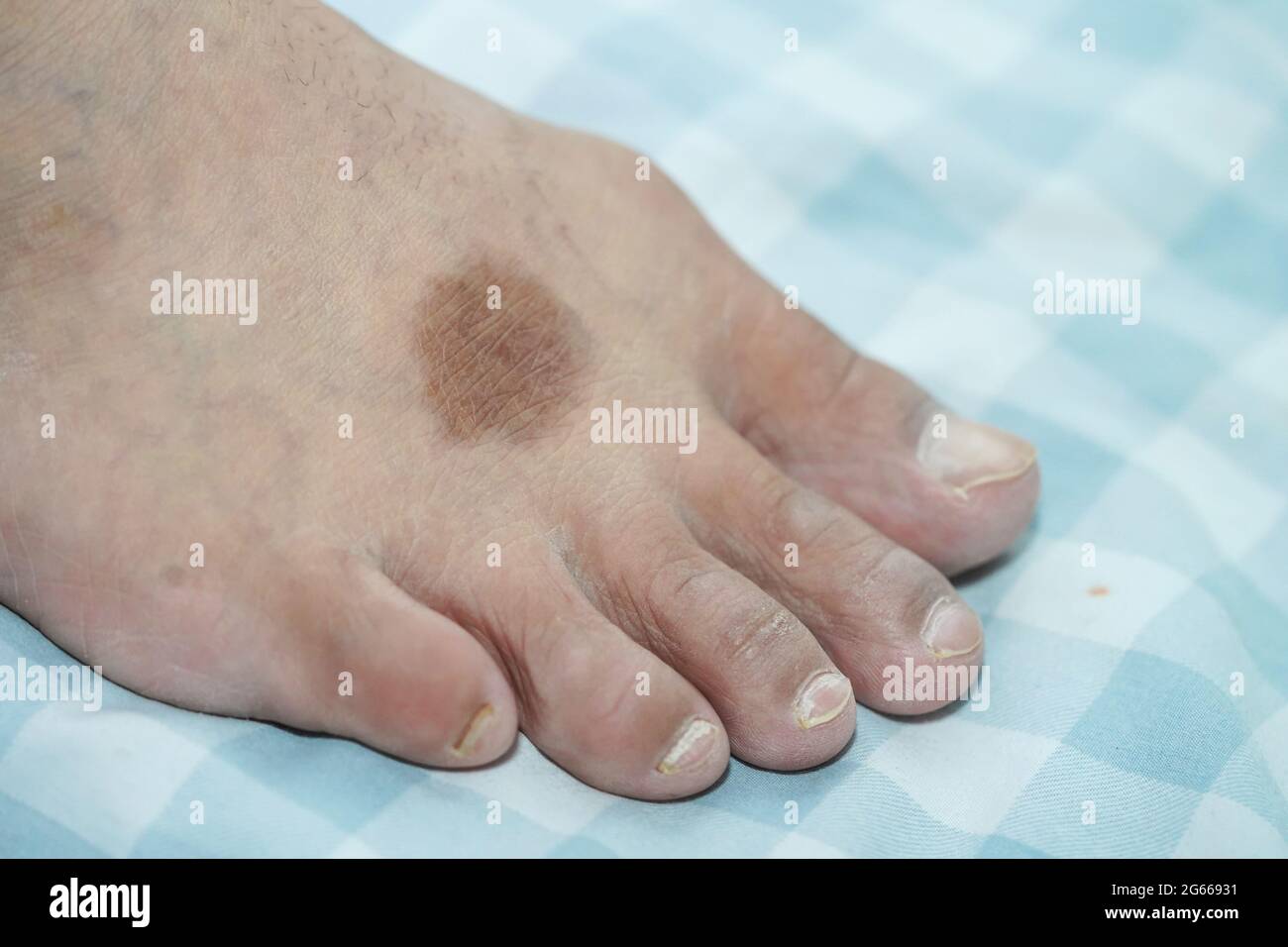 Ugly feet hi-res stock photography and images - Alamy