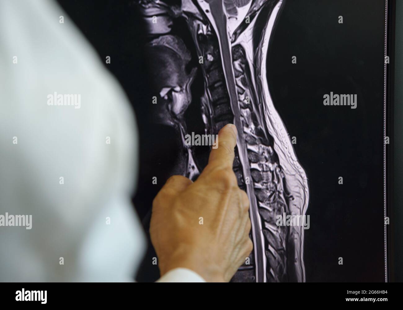 Doctor Pointing At MRI Of Cervical Spondylosis On Computer Screen Stock Photo Alamy