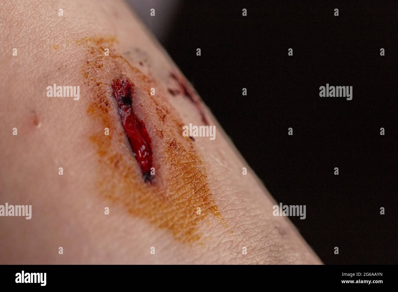 a deep cut on a human body part Stock Photo