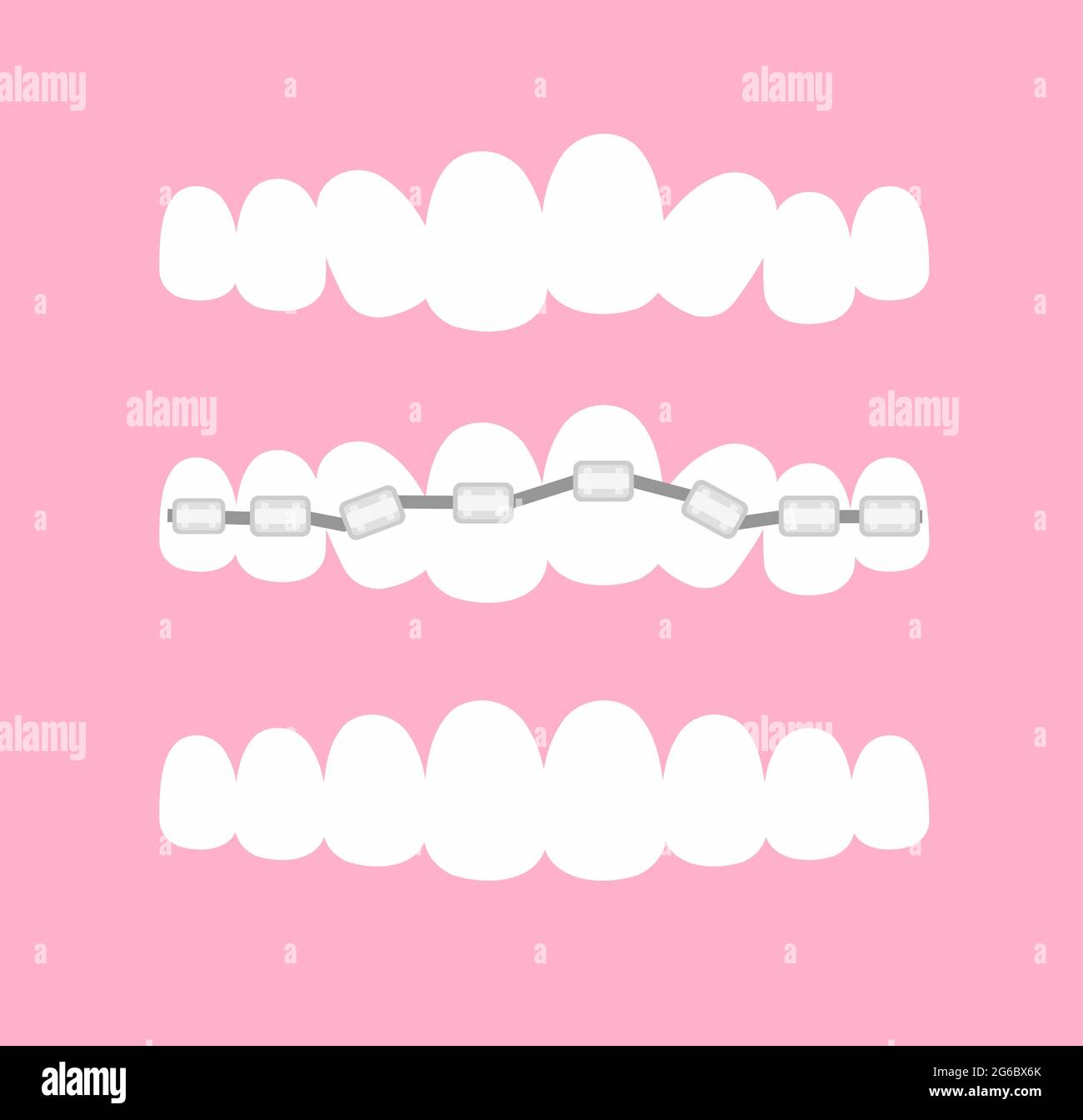 Vector illustration of the stages of orthodontic treatment braces on teeth . Teeth before and after braces on pink background in flat cartoon style. Stock Vector