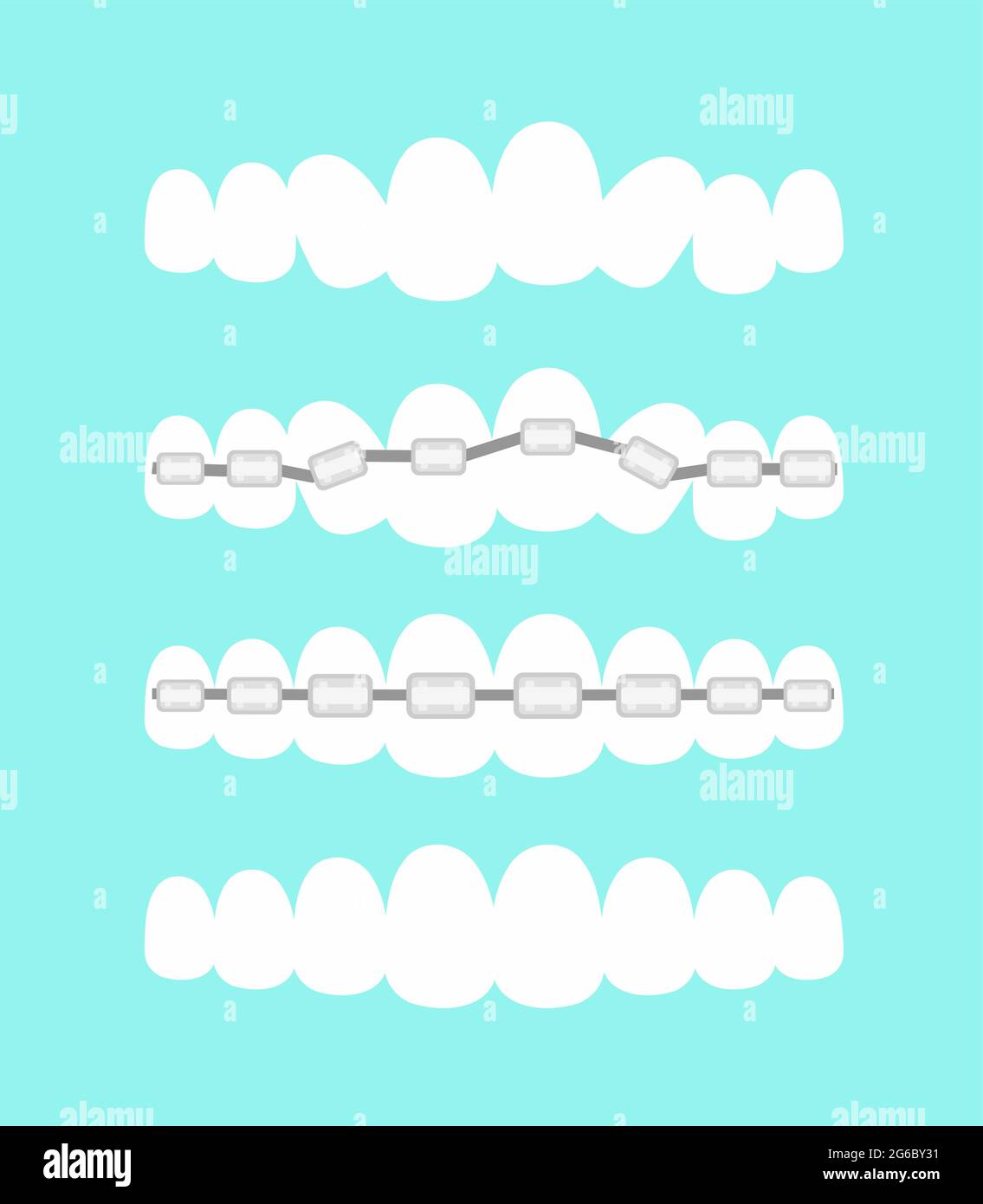 Vector illustration set of teeth, dental orthodontics treatment with teeth braces, process of level teeth, beautiful smile in cartoon flat style. Stock Vector