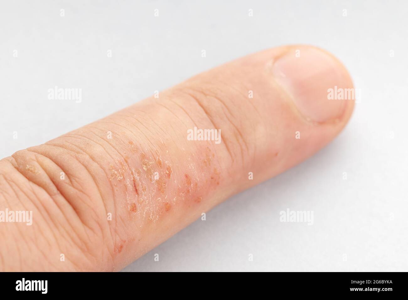 Close up of Eczema on finger. Skin disease Stock Photo