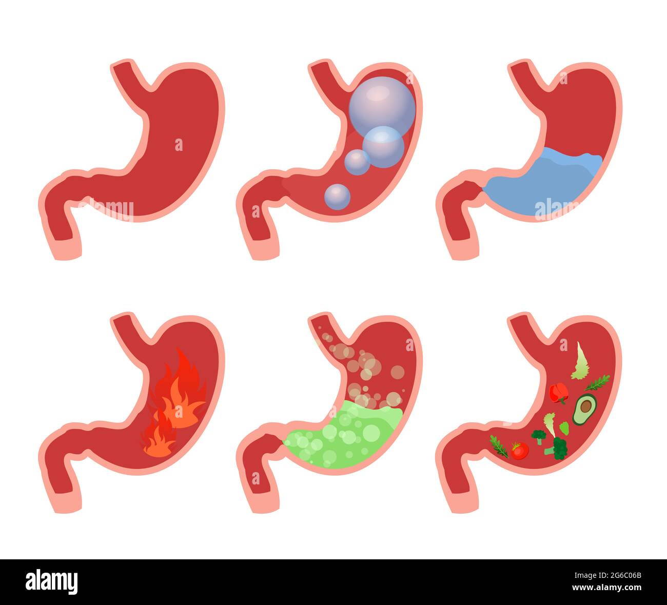 Vector illustration cartoon set medical illustrations of Abdominal bloated stomach. Different types of stomach sickness. Gas, alcohol, swelling Stock Vector
