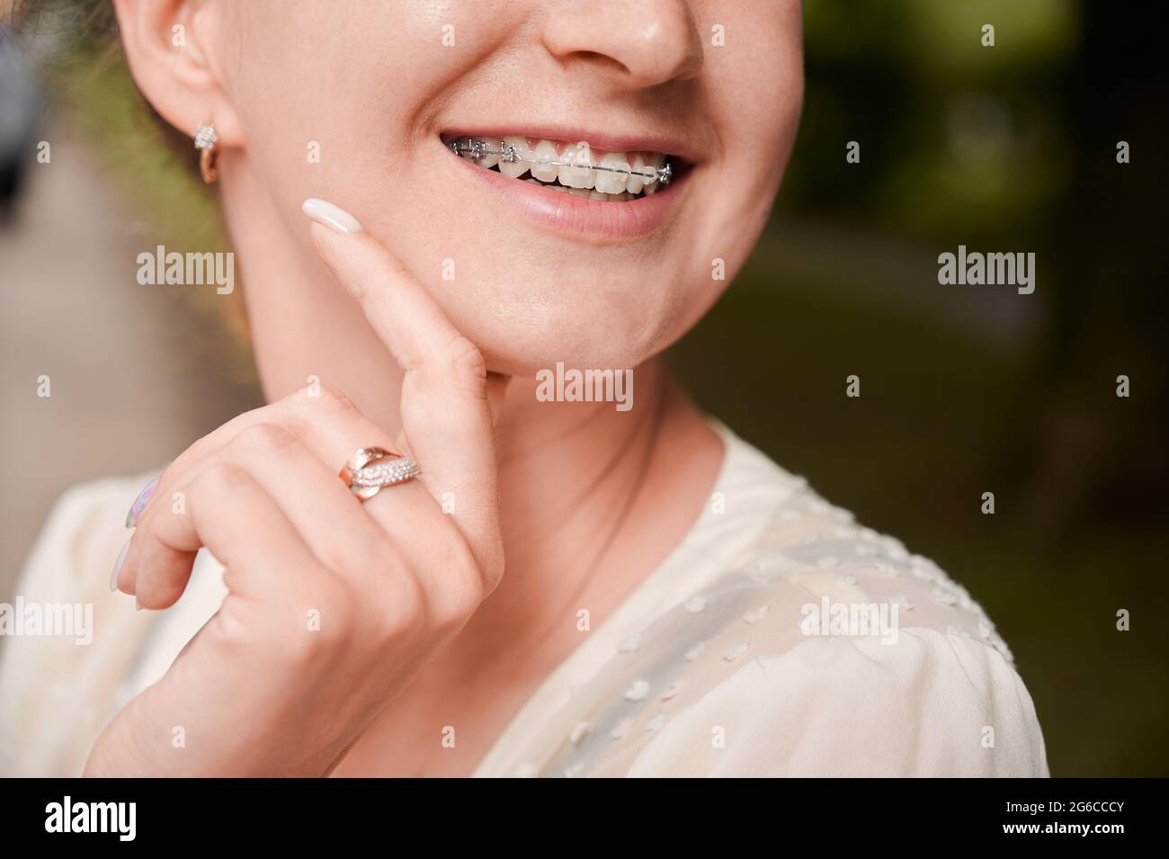 Close up of woman with orthodontic brackets on teeth touching chin and smiling. Patient
