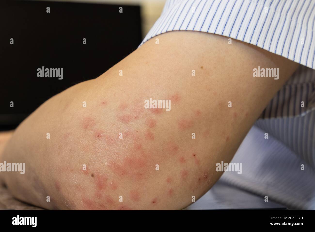 mosquito bits skin of man's elbow, creating a large area of bump, itching, swelling, soreness, and redness. hand cannot help scratching Stock Photo