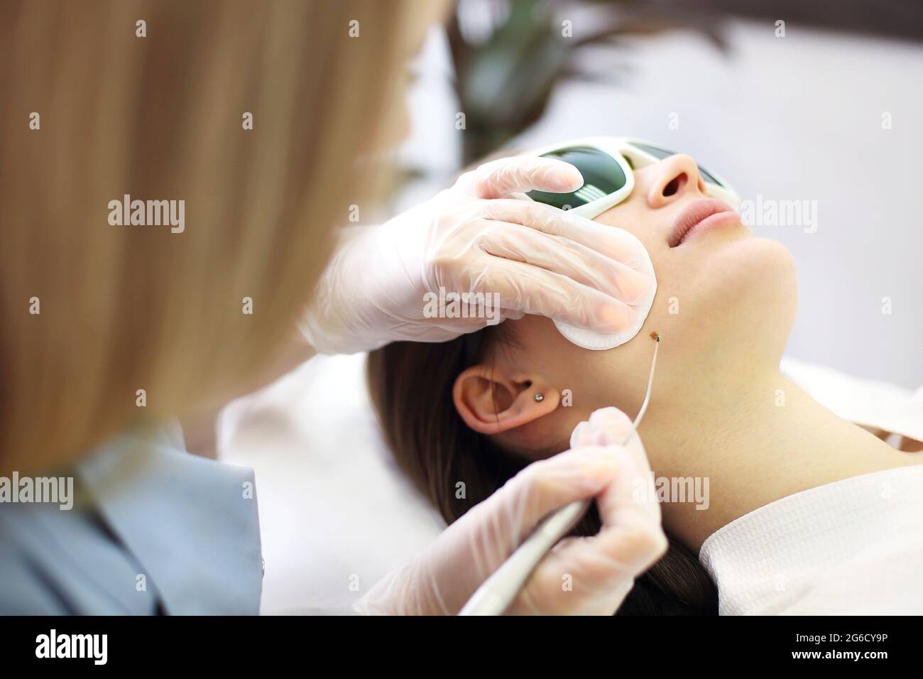 Laser mole removal on a woman's neck in a beauty salon. Close up Stock  Photo - Alamy