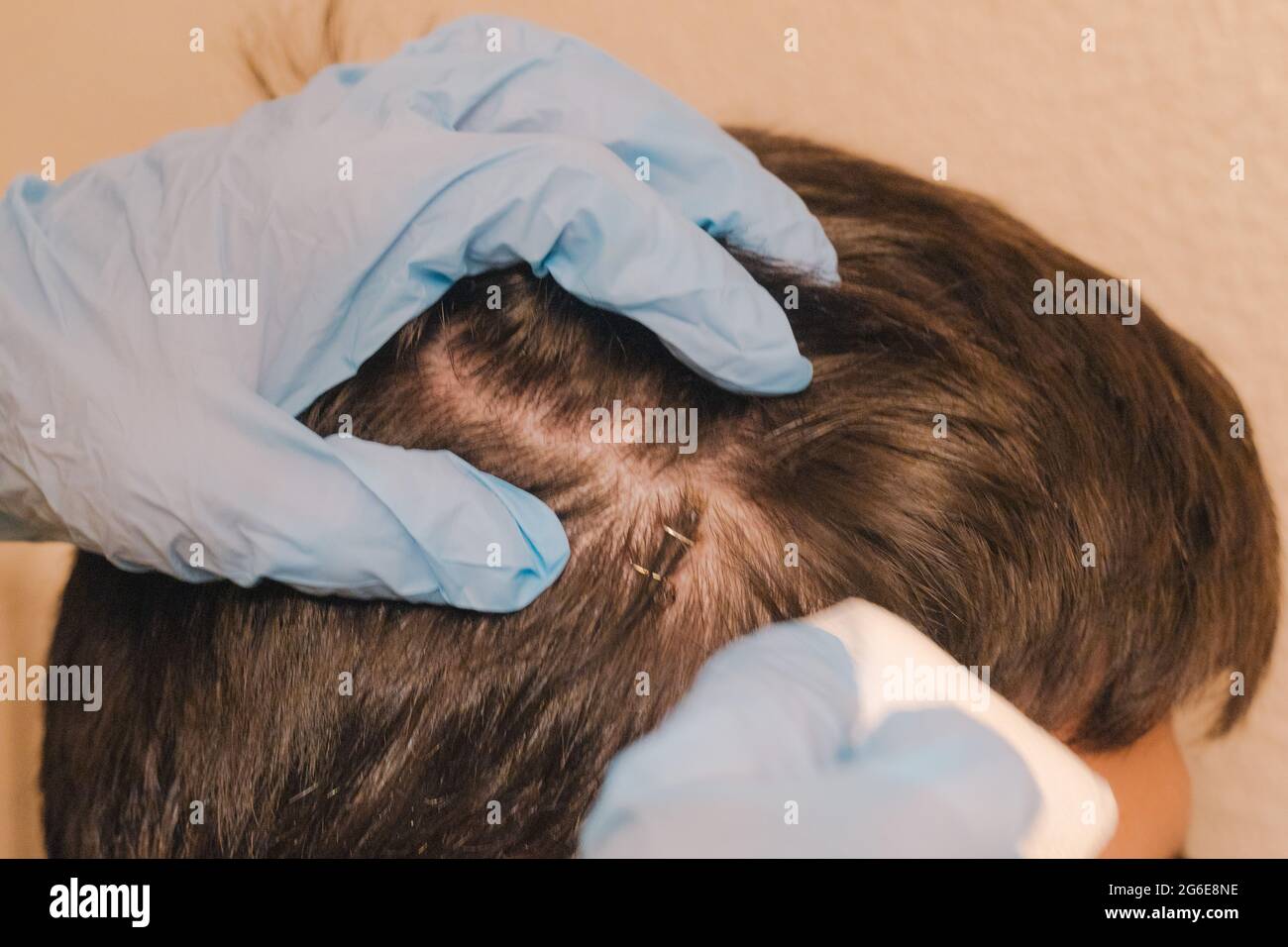 doctor with gloves showing head wound with two stitches placed with