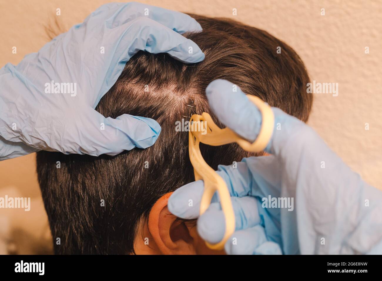 Head wound stitches hi-res stock photography and images - Alamy