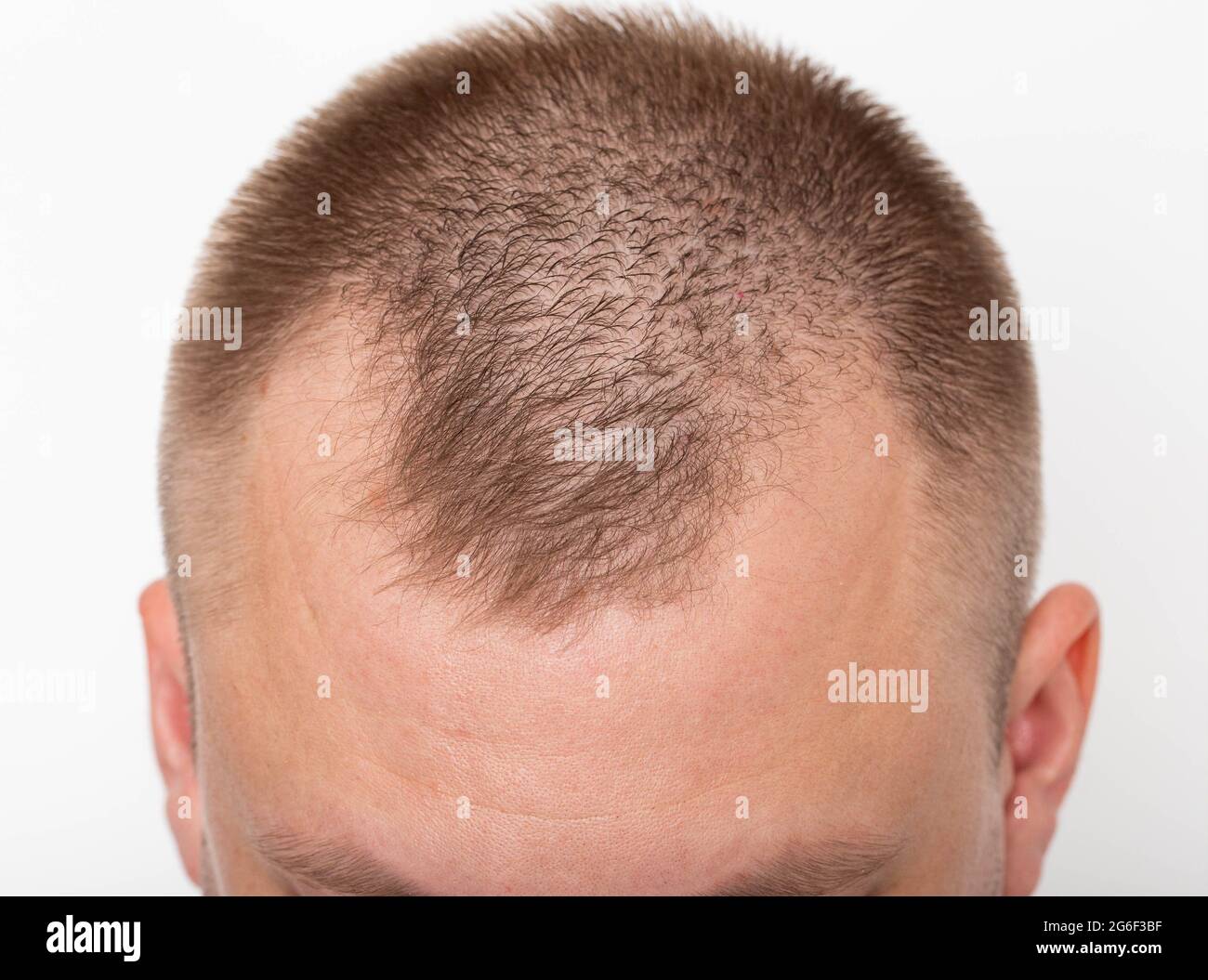 Frontal bald patches hires stock photography and images Alamy