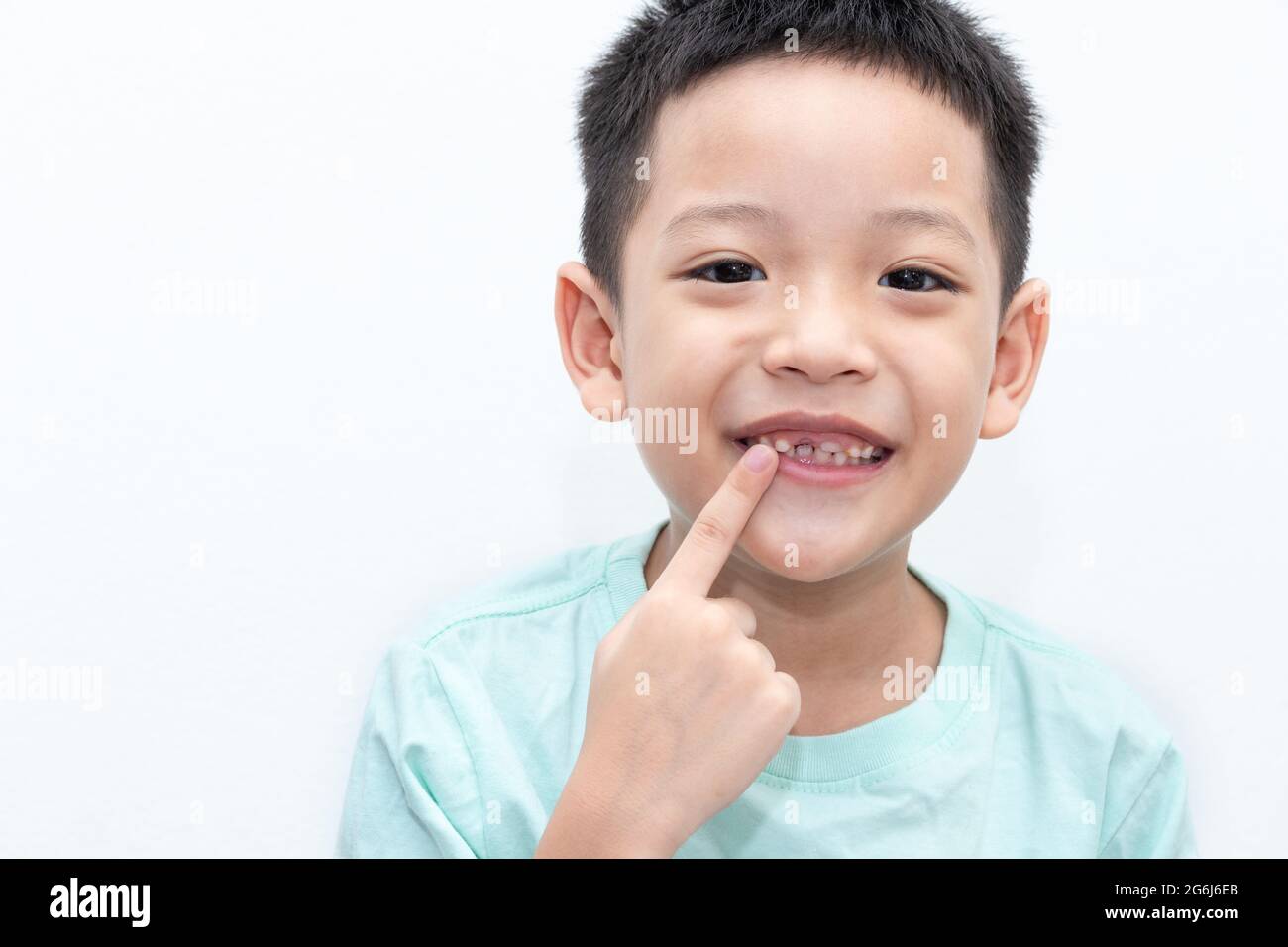 Asian little boy was pointing at his permanent teeth are growing. A 5-year-old boy whose upper milk tooth incisor fell out. Kid happy open mouth show Stock Photo