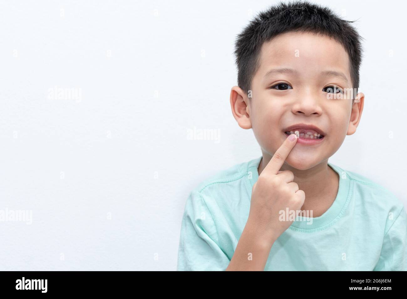 Asian little boy was pointing at his permanent teeth are growing. A 5-year-old boy whose upper milk tooth incisor fell out. Kid happy open mouth show Stock Photo