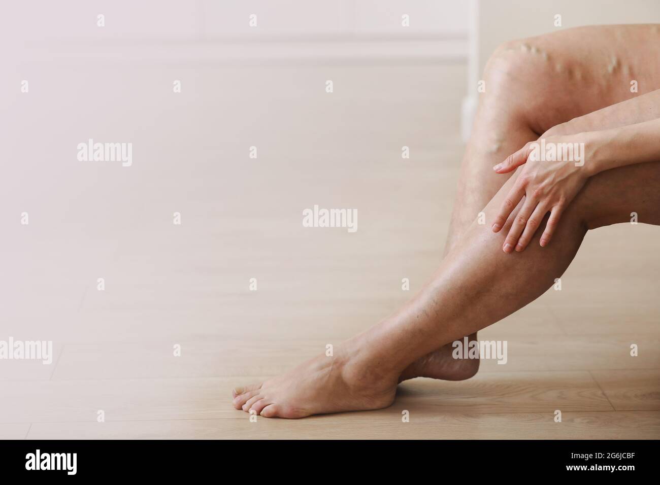 Painful varicose and spider veins on active womans legs, selfhelping