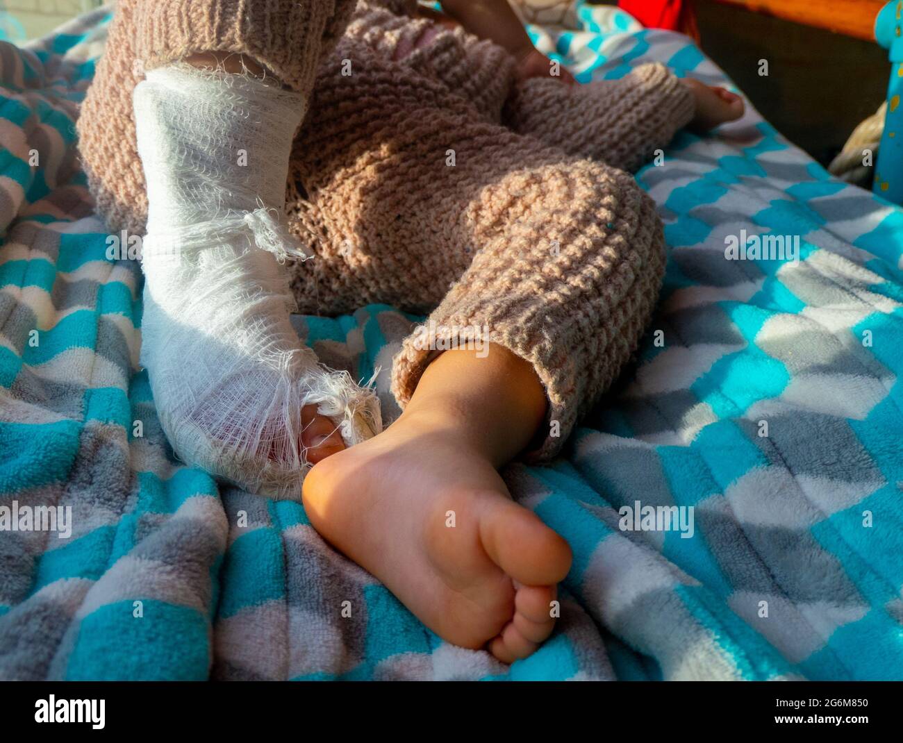 Child with bandage on leg heel fracture. Broken right foot, bone, calf