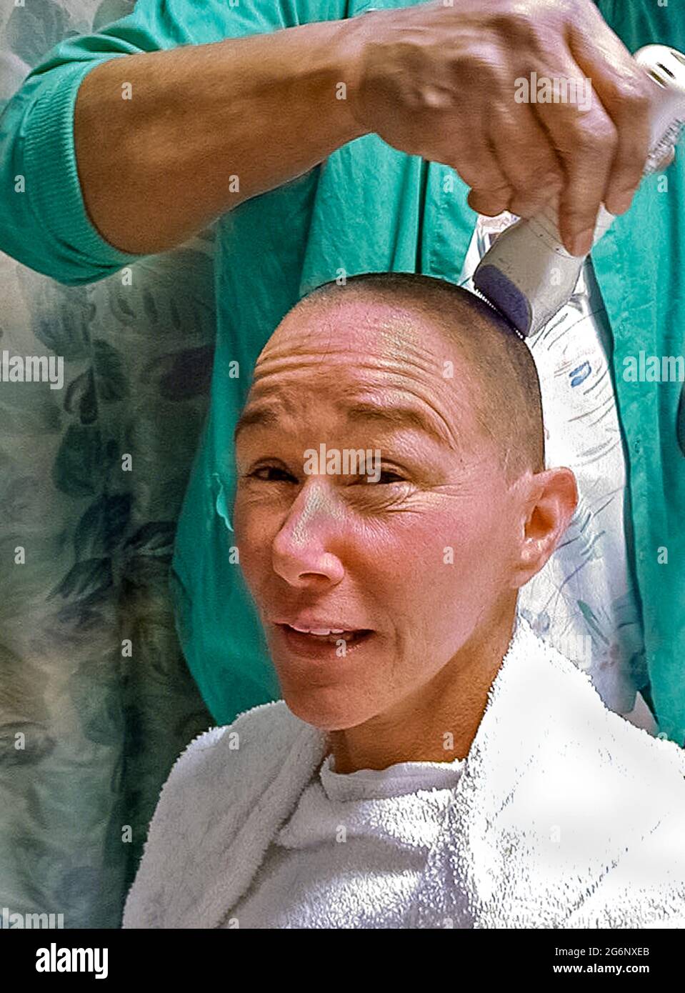 An American woman who suffers from epilepsy has her head shaved with an electric razor in a hospital prior to an operation on her brain. Her hair was totally removed before the surgeon cut into her scalp and skull (cranium) to perform a temporal lobectomy, a surgery that can lower the number of seizures, make them less severe, or even stop them from happening. During this medical procedure, the doctor removes some of the temporal lobe of her brain where most seizures start. (1st of 7 related images.) Model released. Stock Photo